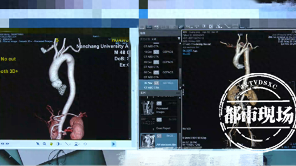 南昌大学二附院创新主动脉夹层治疗技术