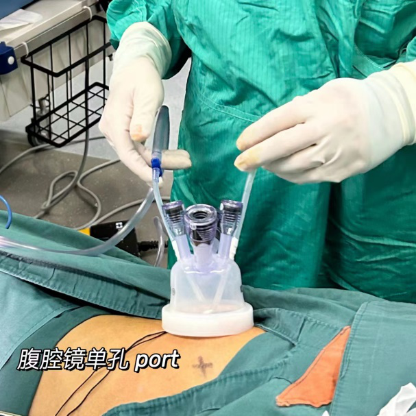 肚脐一个小切口,西安交通大学第一附属医院助花季少女成功脱去「小黄衣」