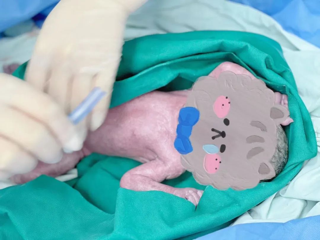 28 岁女子宫颈机能不全！攀枝花市妇幼保健院医生用 3 次宫颈环扎留住「试管龙凤胎」