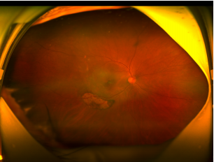 不断拓展眼底病领域「视」野,「医」心守护患者光明——柳州市红十字会医院眼底病与白内障专科篇