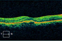 不断拓展眼底病领域「视」野,「医」心守护患者光明——柳州市红十字会医院眼底病与白内障专科篇