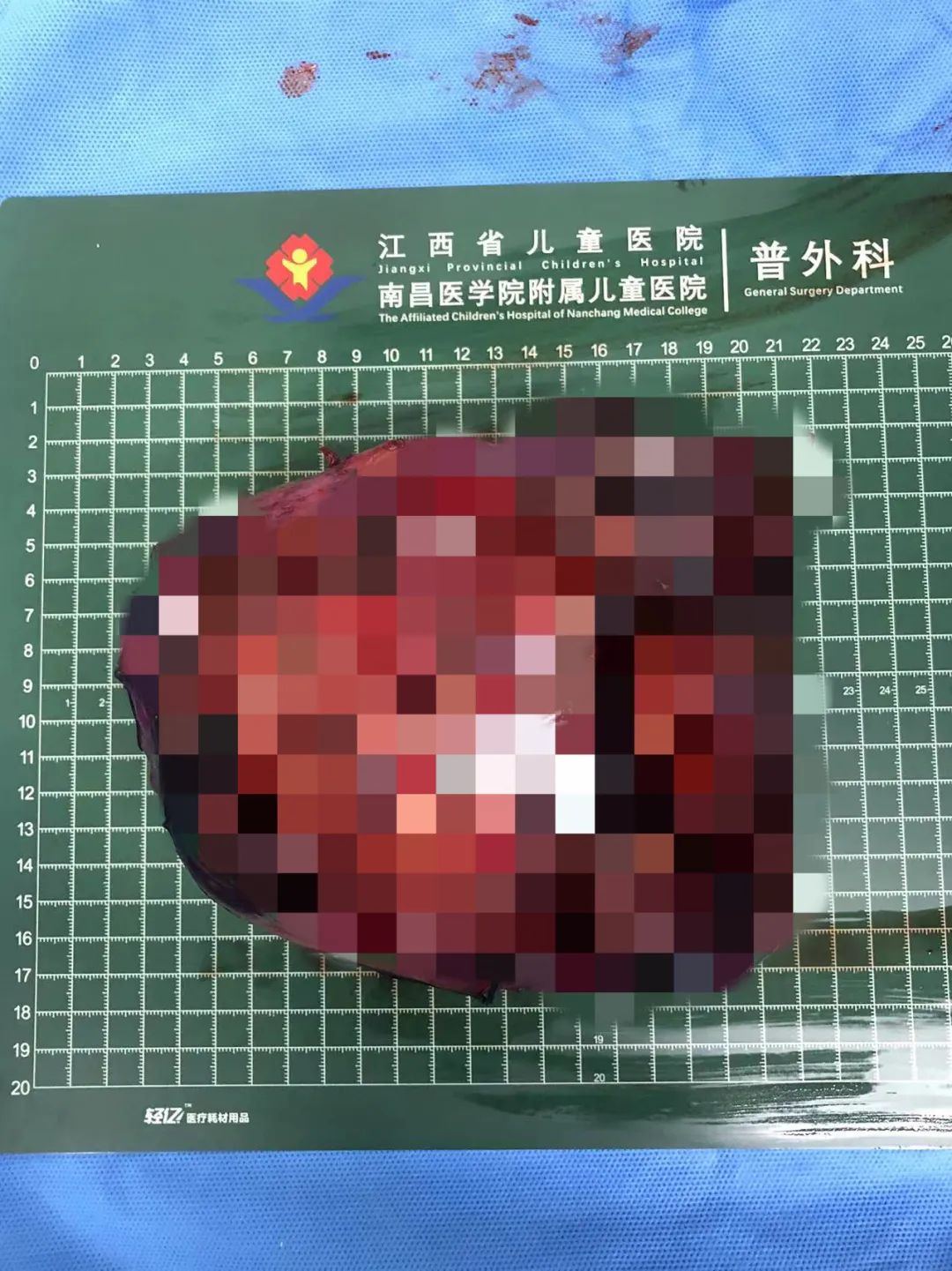 青春期女孩「肚子大」，可能是「藏」有巨大肿瘤