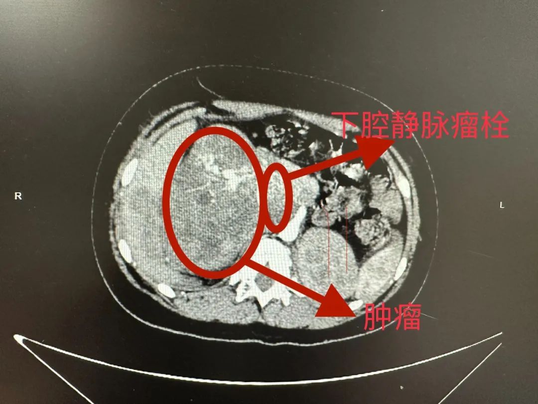 青春期女孩「肚子大」，可能是「藏」有巨大肿瘤