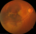 不断拓展眼底病领域「视」野,「医」心守护患者光明——柳州市红十字会医院眼底病与白内障专科篇