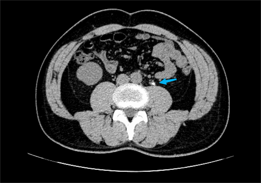 这种痛千万别错当扭伤！趁没严重来个「冲击波」就好