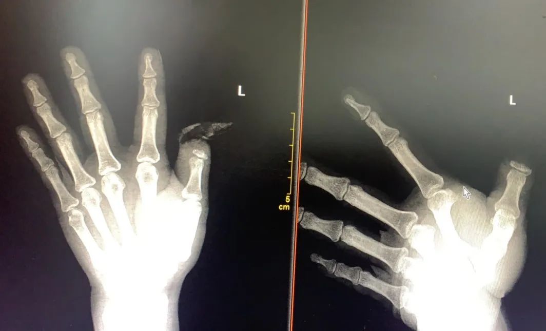 太恐怖了！女子拇指离断并扯出手筋 20 cm！这也能接得回去？