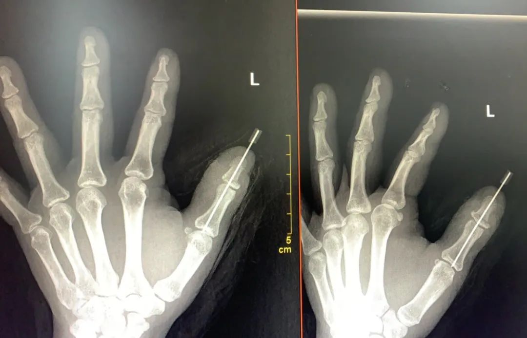 太恐怖了！女子拇指离断并扯出手筋 20 cm！这也能接得回去？