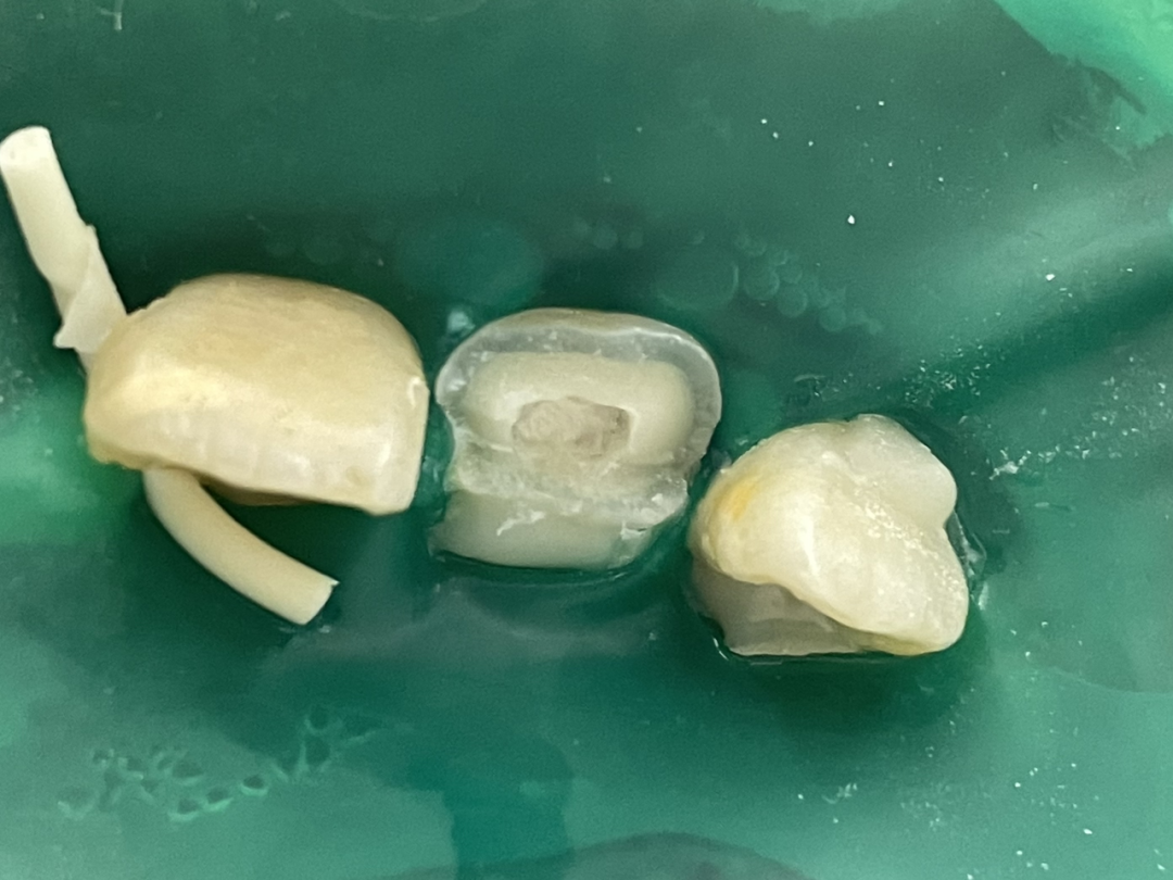 9 岁孩子门牙断折，医生巧手修补如初