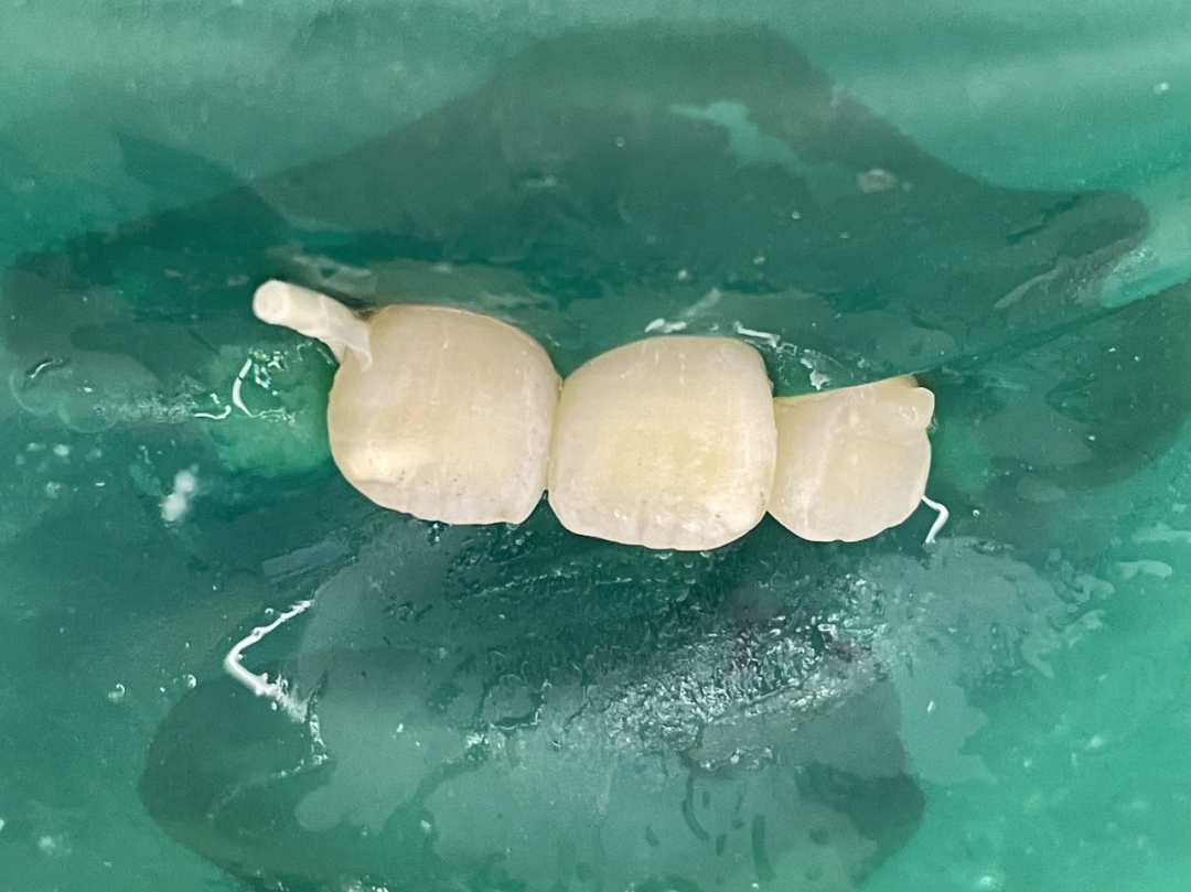 9 岁孩子门牙断折，医生巧手修补如初
