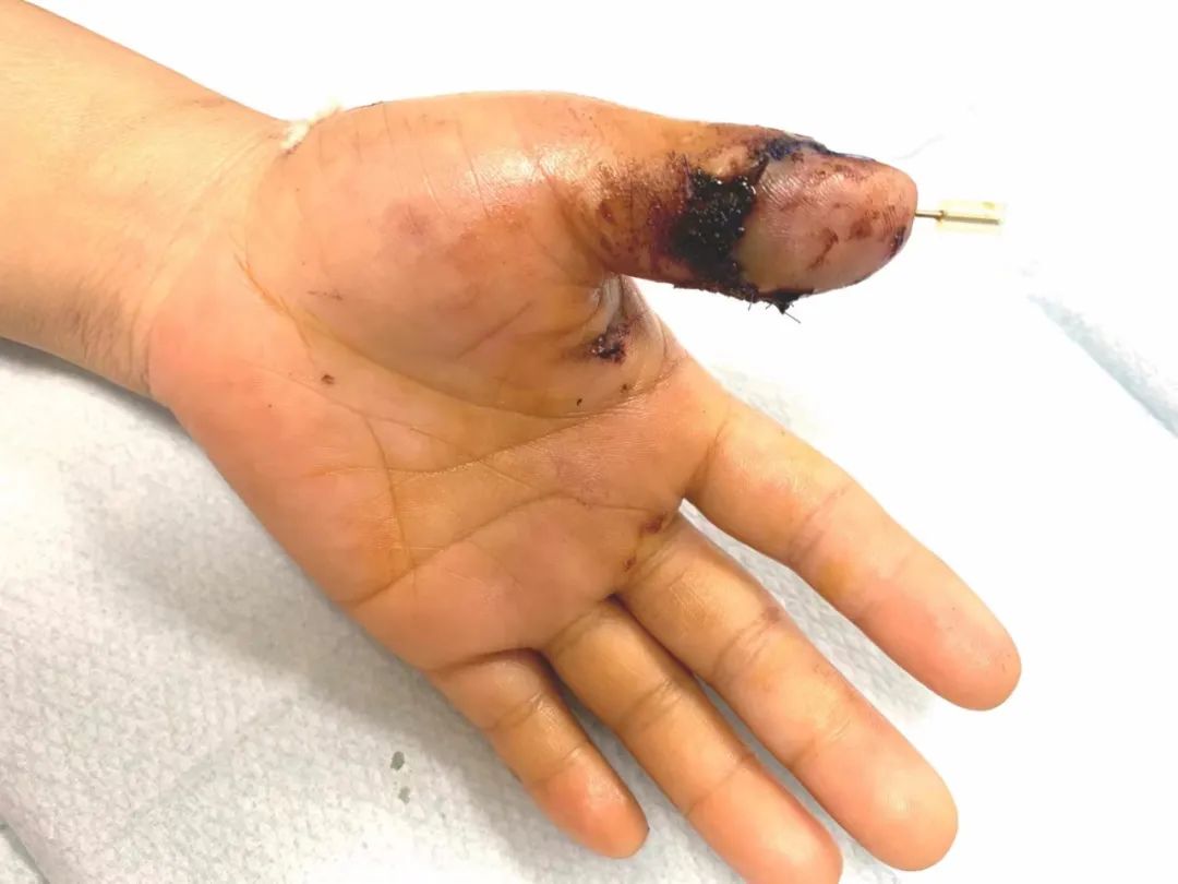 太恐怖了！女子拇指离断并扯出手筋 20 cm！这也能接得回去？