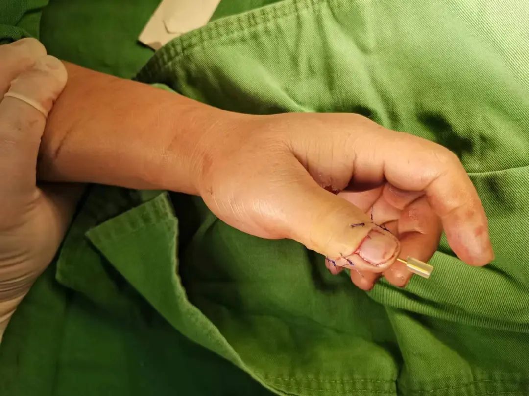 太恐怖了！女子拇指离断并扯出手筋 20 cm！这也能接得回去？