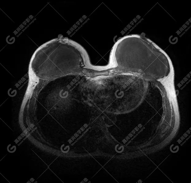 【高尚病例】MR 对乳腺美容术后的评估价值