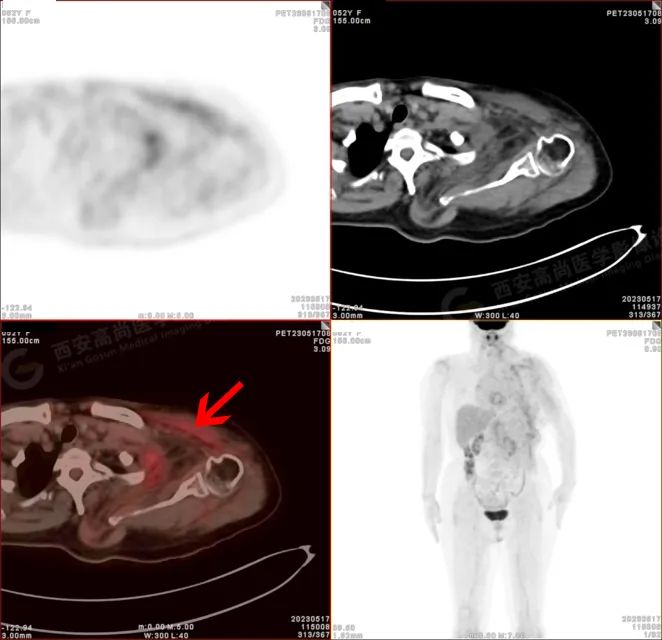 【高尚病例】18F-FDG PETCT 腹外型韧带样纤维瘤病一例