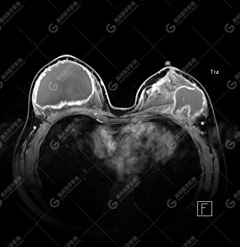 【高尚病例】MR 对乳腺美容术后的评估价值