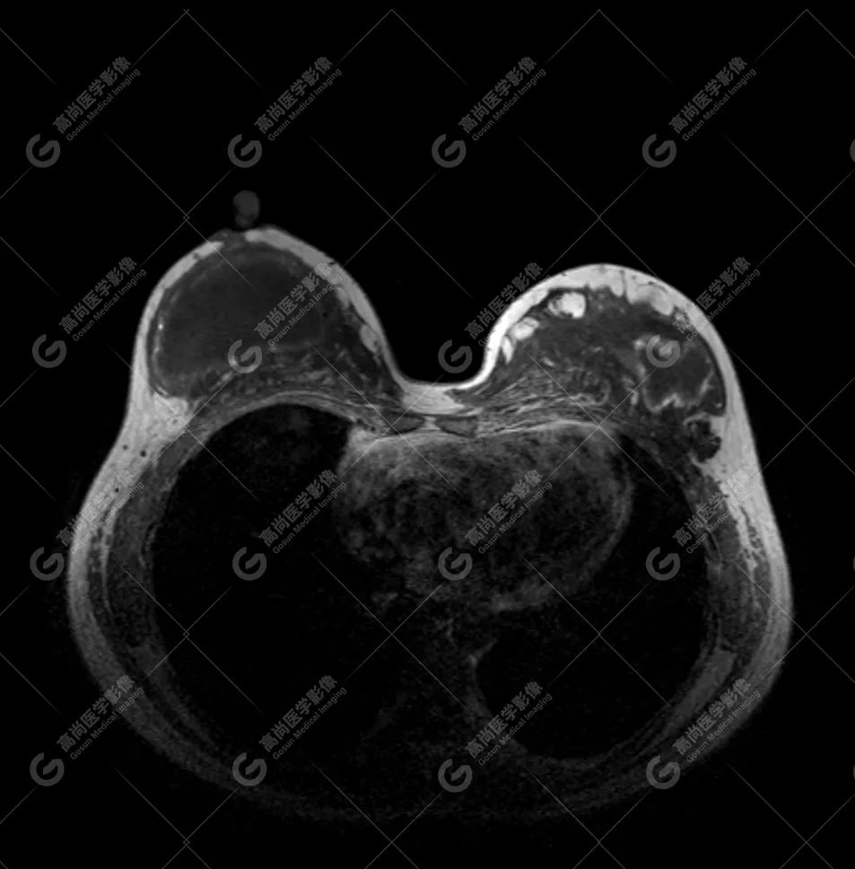 【高尚病例】MR 对乳腺美容术后的评估价值