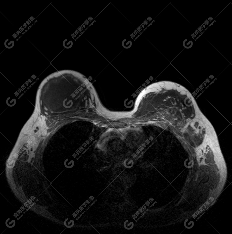 【高尚病例】MR 对乳腺美容术后的评估价值