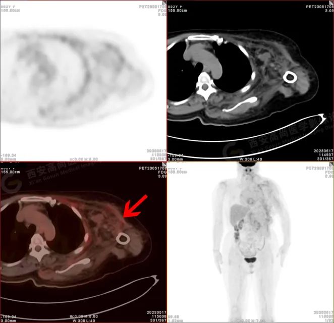 【高尚病例】18F-FDG PETCT 腹外型韧带样纤维瘤病一例