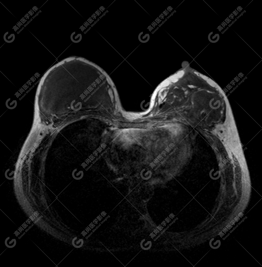 【高尚病例】MR 对乳腺美容术后的评估价值