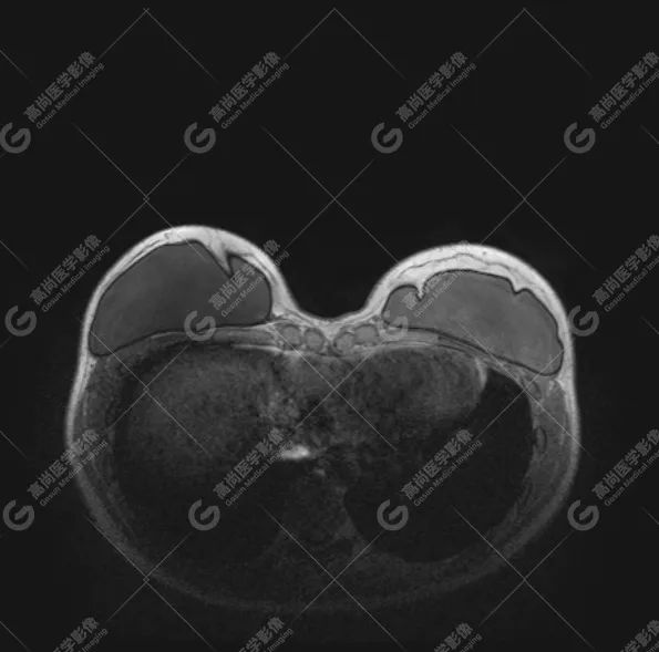 【高尚病例】MR 对乳腺美容术后的评估价值