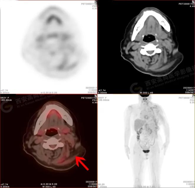 【高尚病例】18F-FDG PETCT 腹外型韧带样纤维瘤病一例