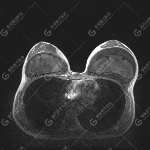 【高尚病例】MR 对乳腺美容术后的评估价值