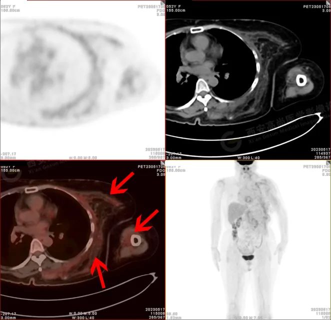 【高尚病例】18F-FDG PETCT 腹外型韧带样纤维瘤病一例