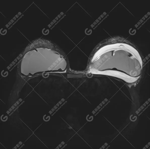 【高尚病例】MR 对乳腺美容术后的评估价值