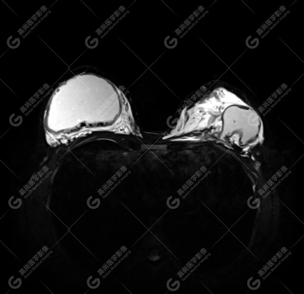 【高尚病例】MR 对乳腺美容术后的评估价值