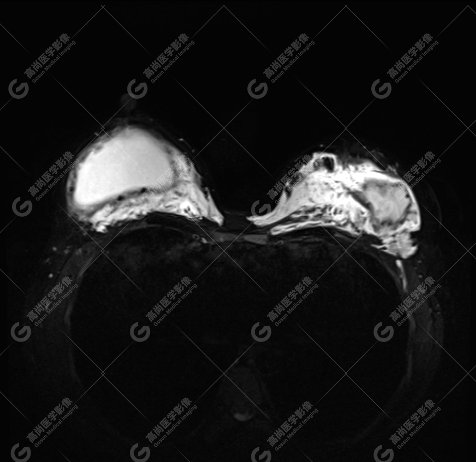 【高尚病例】MR 对乳腺美容术后的评估价值