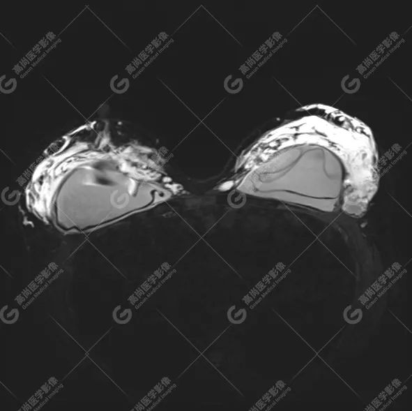 【高尚病例】MR 对乳腺美容术后的评估价值