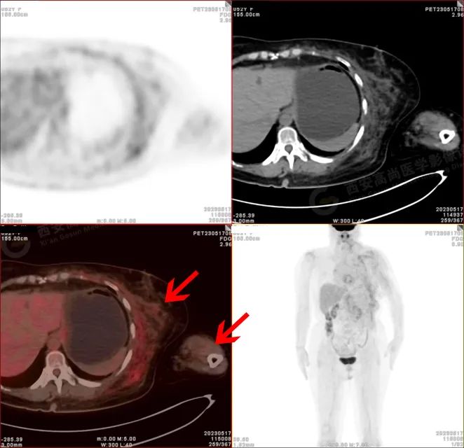 【高尚病例】18F-FDG PETCT 腹外型韧带样纤维瘤病一例