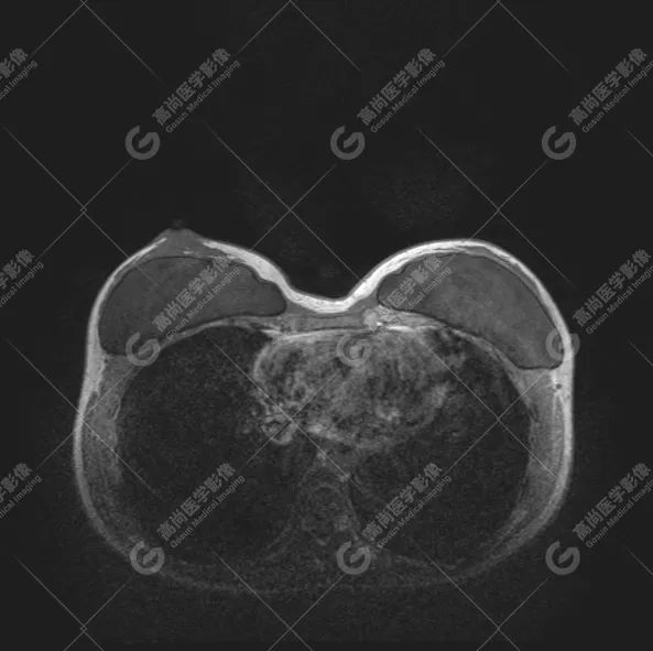【高尚病例】MR 对乳腺美容术后的评估价值