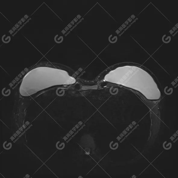 【高尚病例】MR 对乳腺美容术后的评估价值