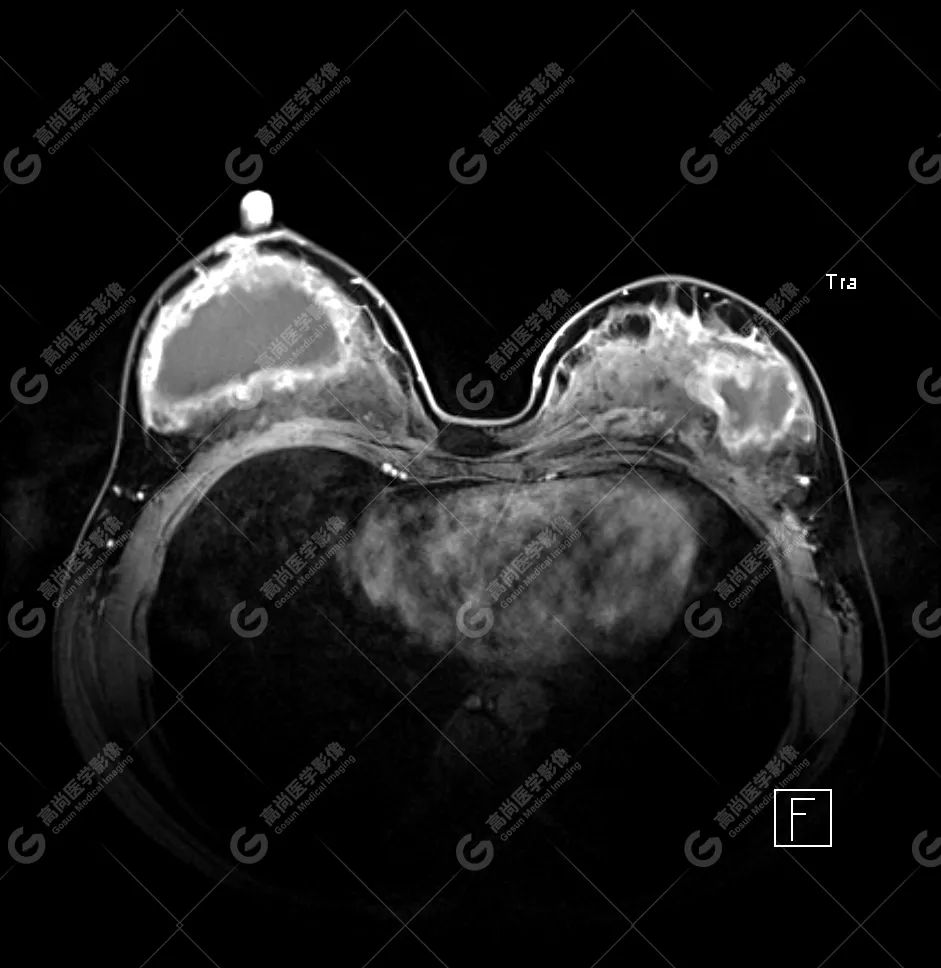 【高尚病例】MR 对乳腺美容术后的评估价值