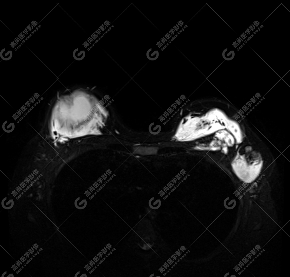 【高尚病例】MR 对乳腺美容术后的评估价值