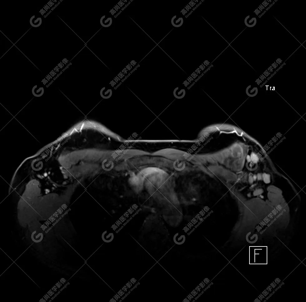 【高尚病例】MR 对乳腺美容术后的评估价值