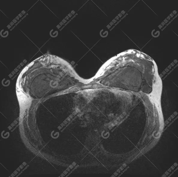 【高尚病例】MR 对乳腺美容术后的评估价值