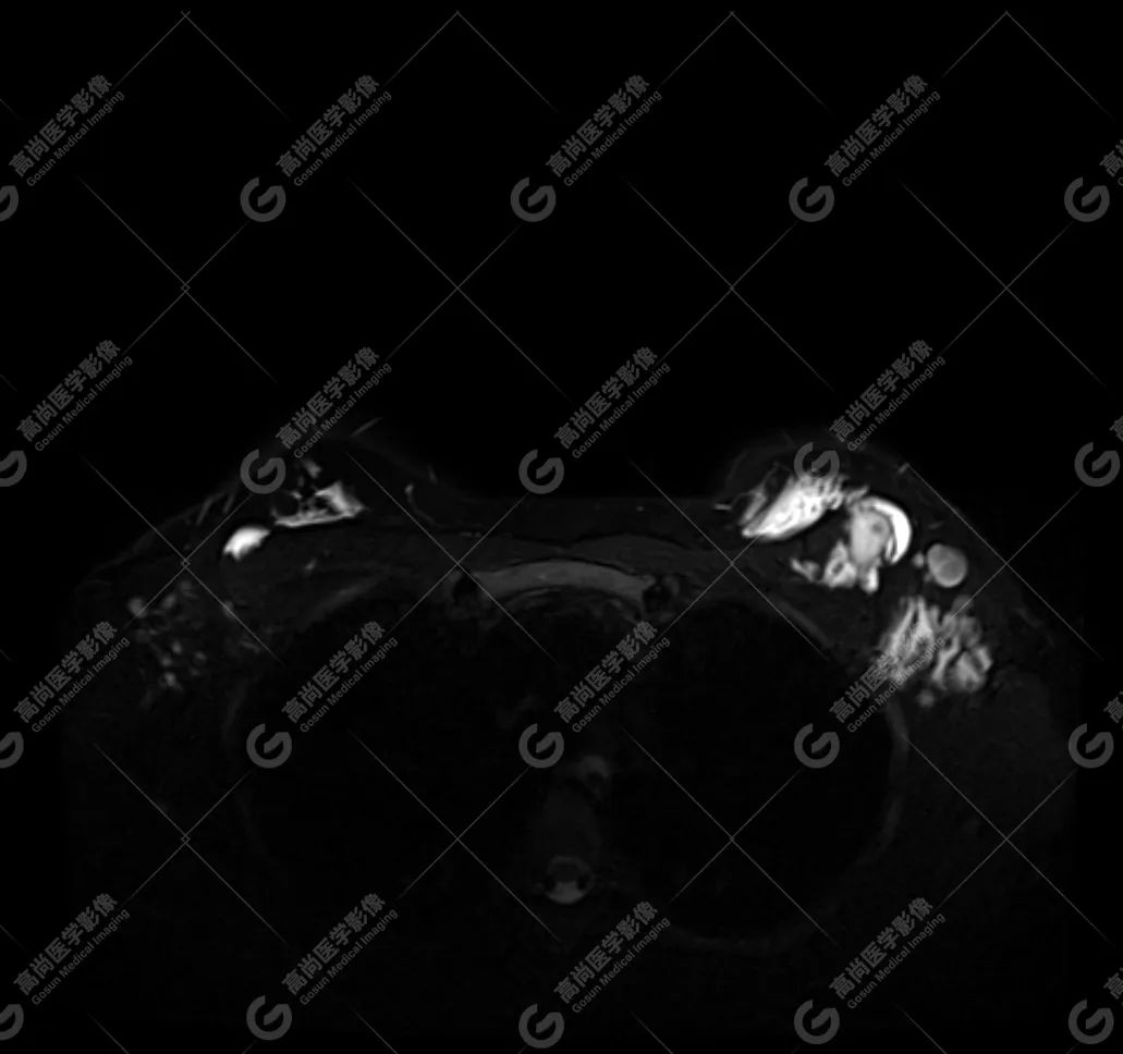 【高尚病例】MR 对乳腺美容术后的评估价值