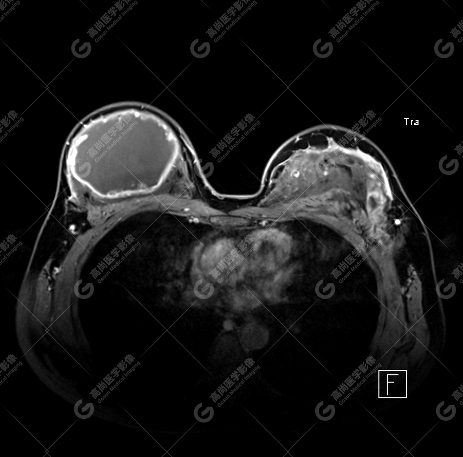 【高尚病例】MR 对乳腺美容术后的评估价值