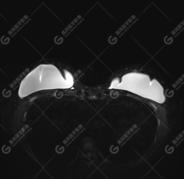 【高尚病例】MR 对乳腺美容术后的评估价值