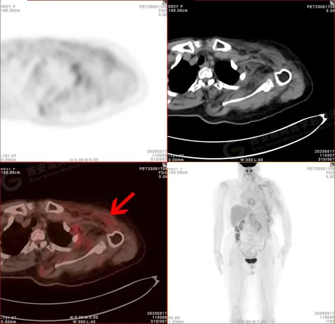 【高尚病例】18F-FDG PETCT 腹外型韧带样纤维瘤病一例