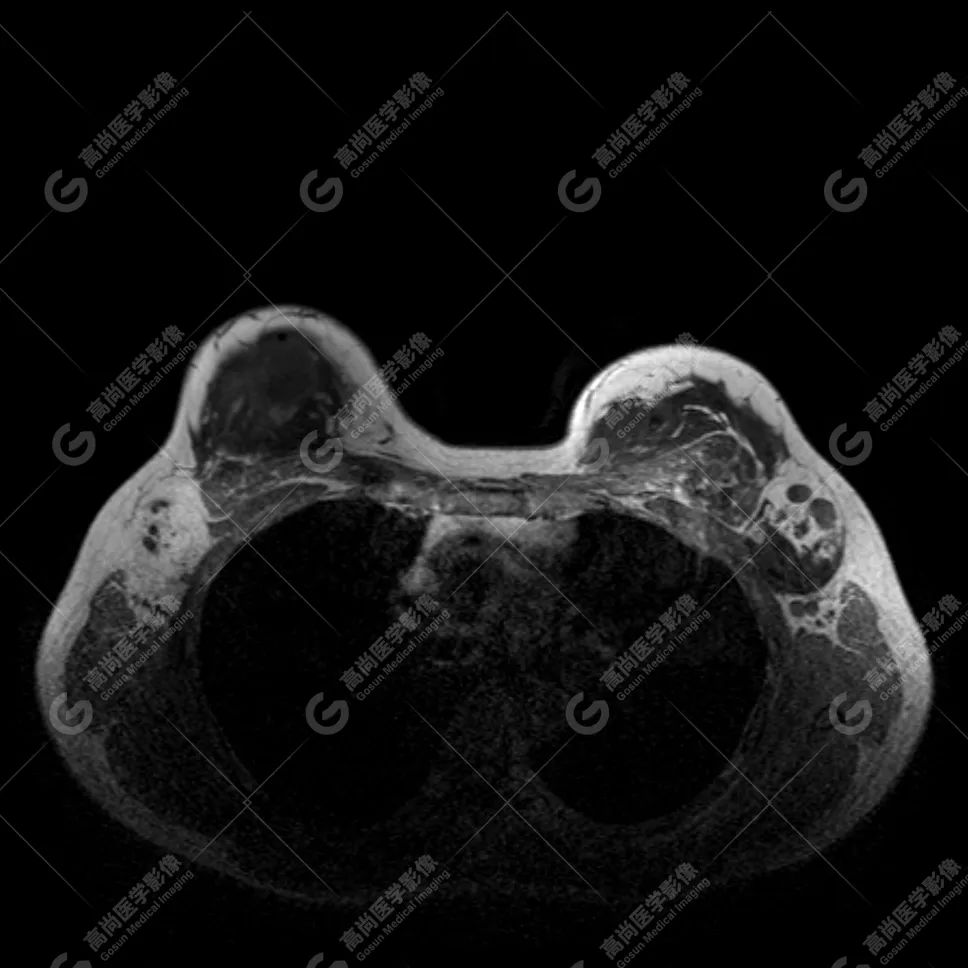 【高尚病例】MR 对乳腺美容术后的评估价值