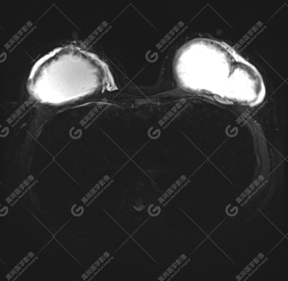 【高尚病例】MR 对乳腺美容术后的评估价值