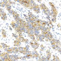 鼠抗人BCA-225单克隆抗体  TDCBM-0020