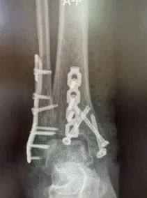 喀什地区第一人民医院创伤骨科完成一例高难度陈旧性后侧 Pilon 骨折手术