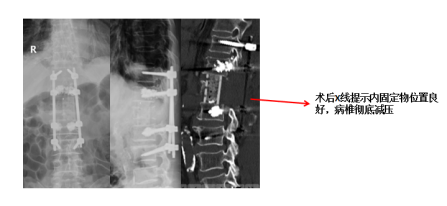 老人反复腰痛竟是「骨转移」，医生提醒：警惕这种「腰酸背痛」