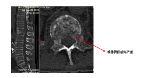 老人反复腰痛竟是「骨转移」，医生提醒：警惕这种「腰酸背痛」