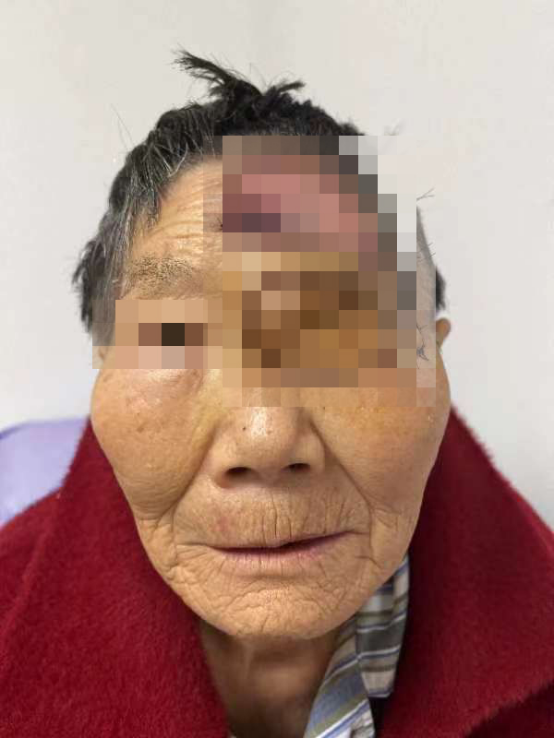 成都京东方医院成功完成眶肿瘤大手术,开启「眶肿瘤」手术新篇章