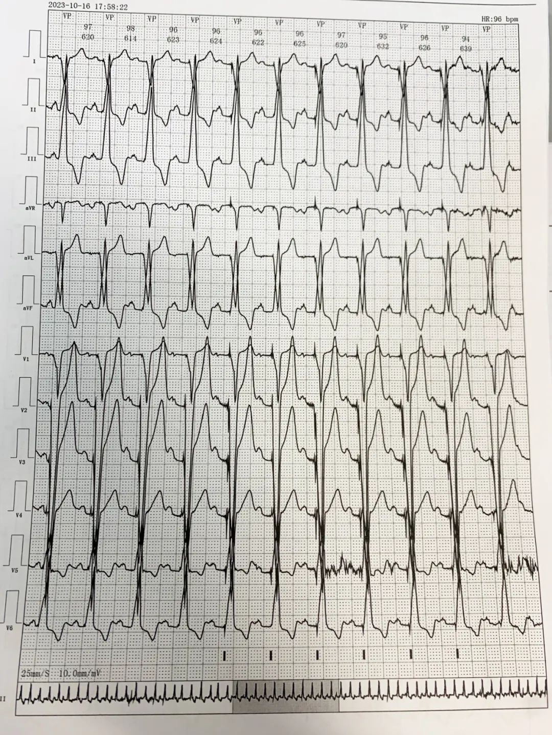 重庆松山医院完成首例无导线双腔起搏器植入
