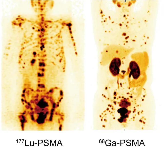 精准打击晚期前列腺癌，河南省肿瘤医院完成全省首例 177Lu（镥）-PSMA-617 临床试验给药
